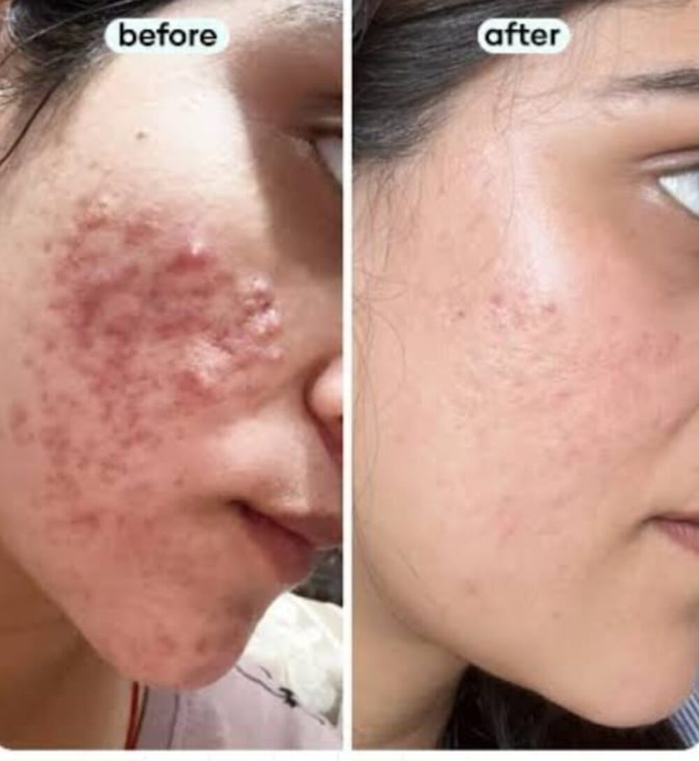 Botanical Elixir Face Serum real patient before and after result