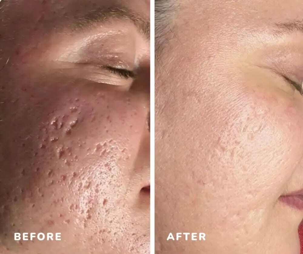 Botanical Elixir Face Serum real patient before and after result