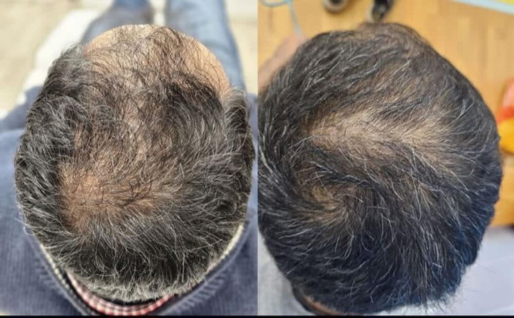 Botanical Elixir Hair Serum real patient before and after result